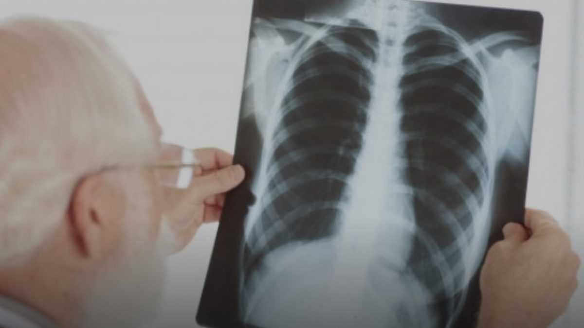 Омикрон е позаразен, но помалку опасен за белите дробови покажува британска студија