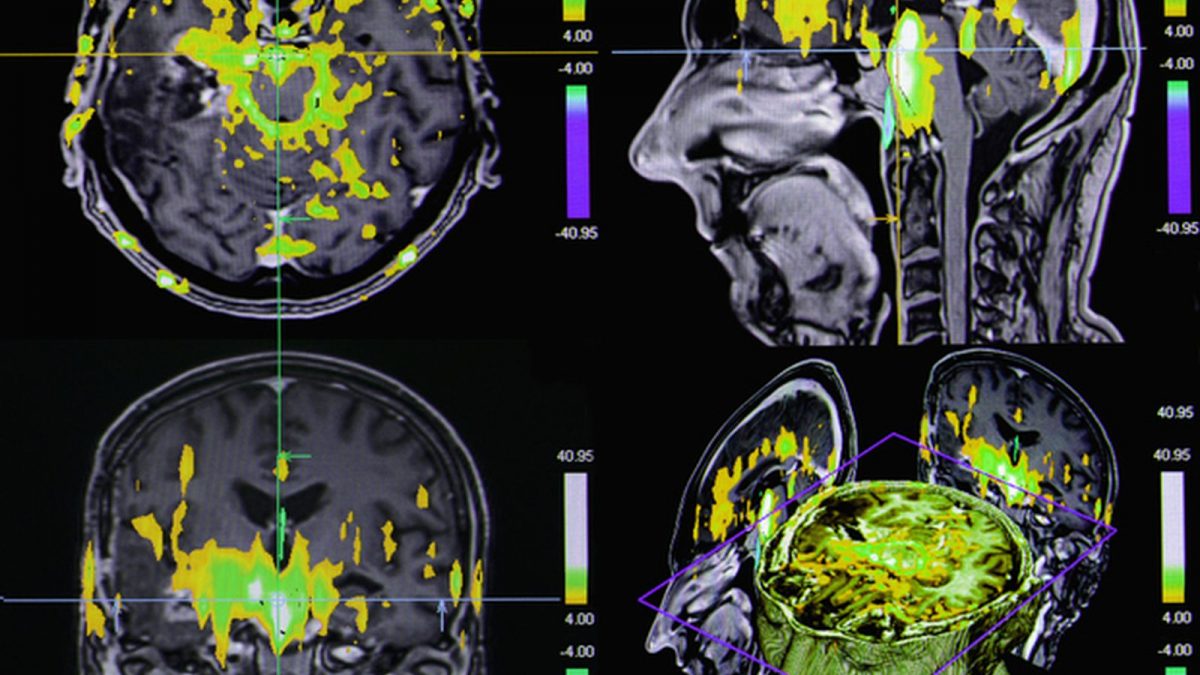 Случајно снимена работата на мозокот на пациент во моментот на смртта и по неа